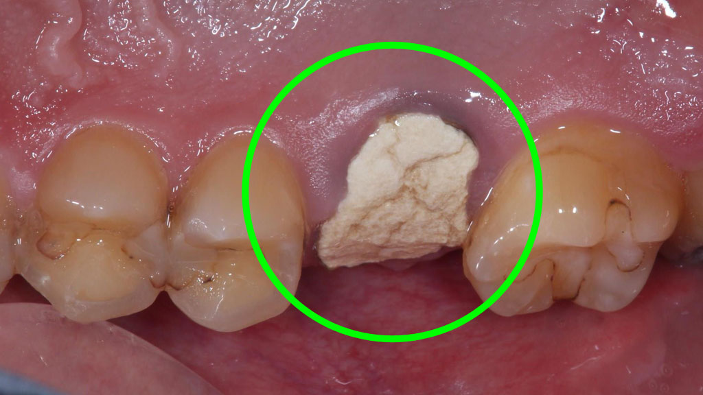 歯牙移植1 STEP10 施術前口蓋