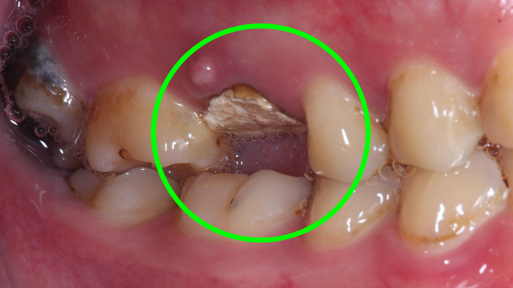 歯牙移植1 STEP10 施術前側方面観