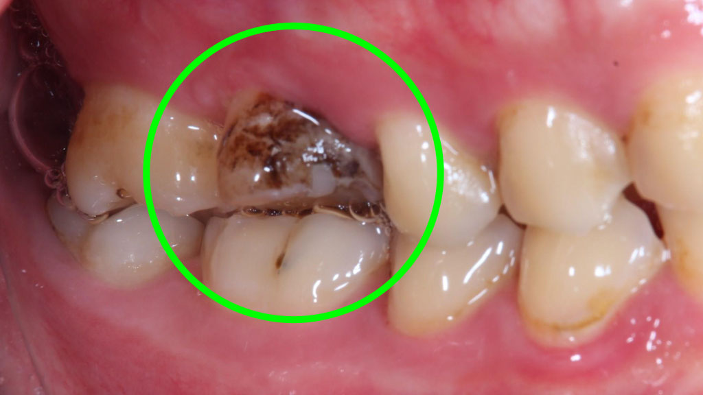 歯牙移植1 STEP10 施術後側方面観