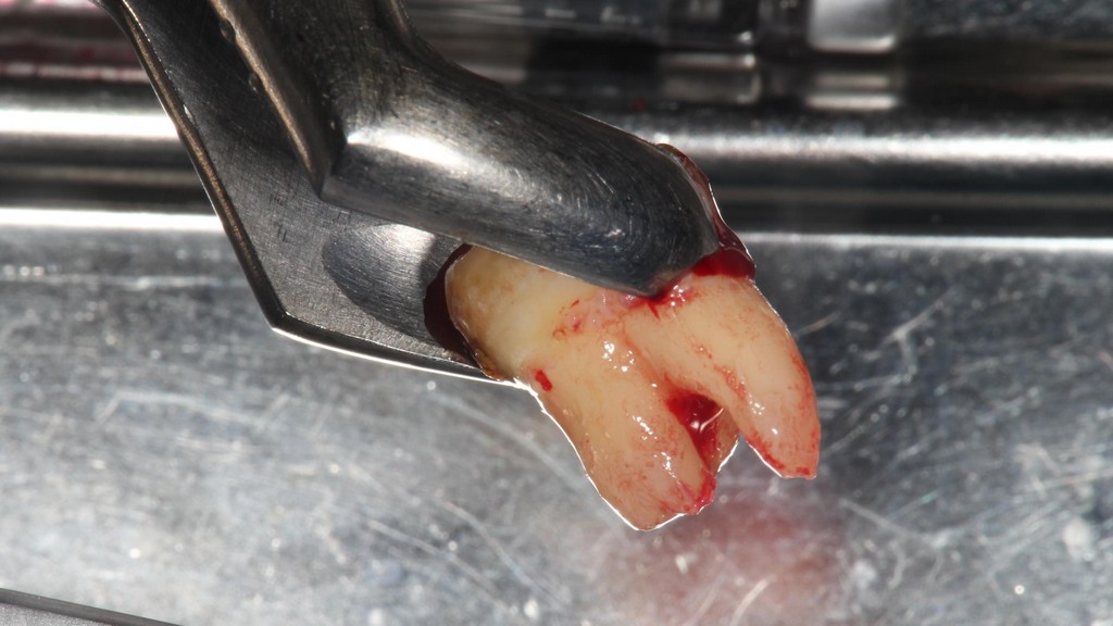 歯牙移植1 STEP3 保存不可能な歯の抜歯窩に後方にあった親知らず