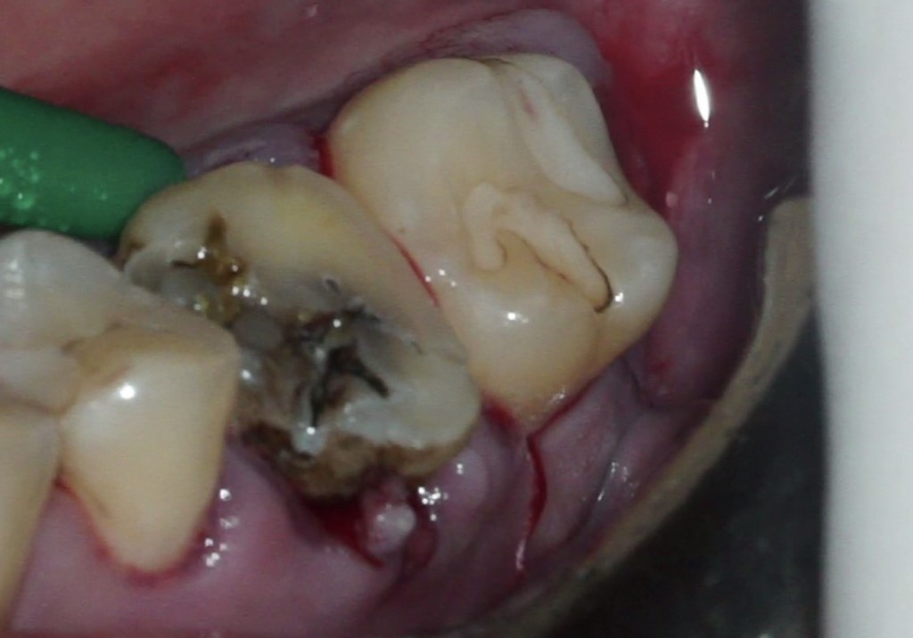 歯牙移植1 STEP3 移植手術