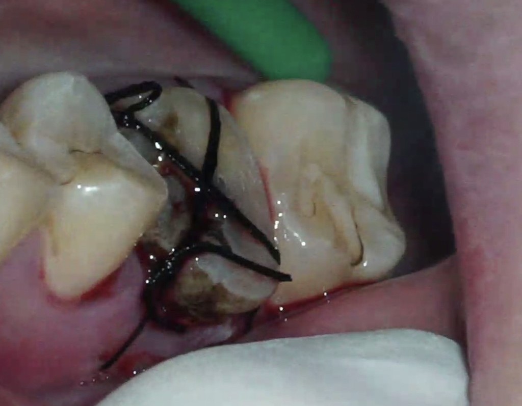 歯牙移植1 STEP4 縫合