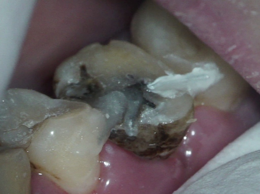 歯牙移植1 STEP5 術後の固定
