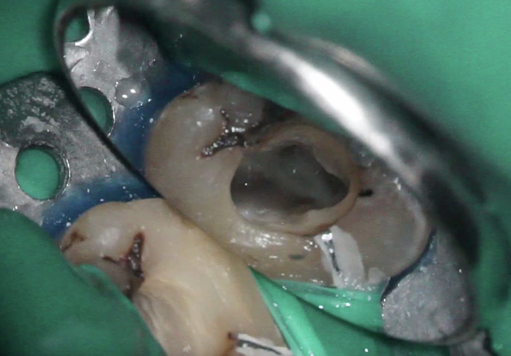 歯牙移植1 STEP6 根管治療