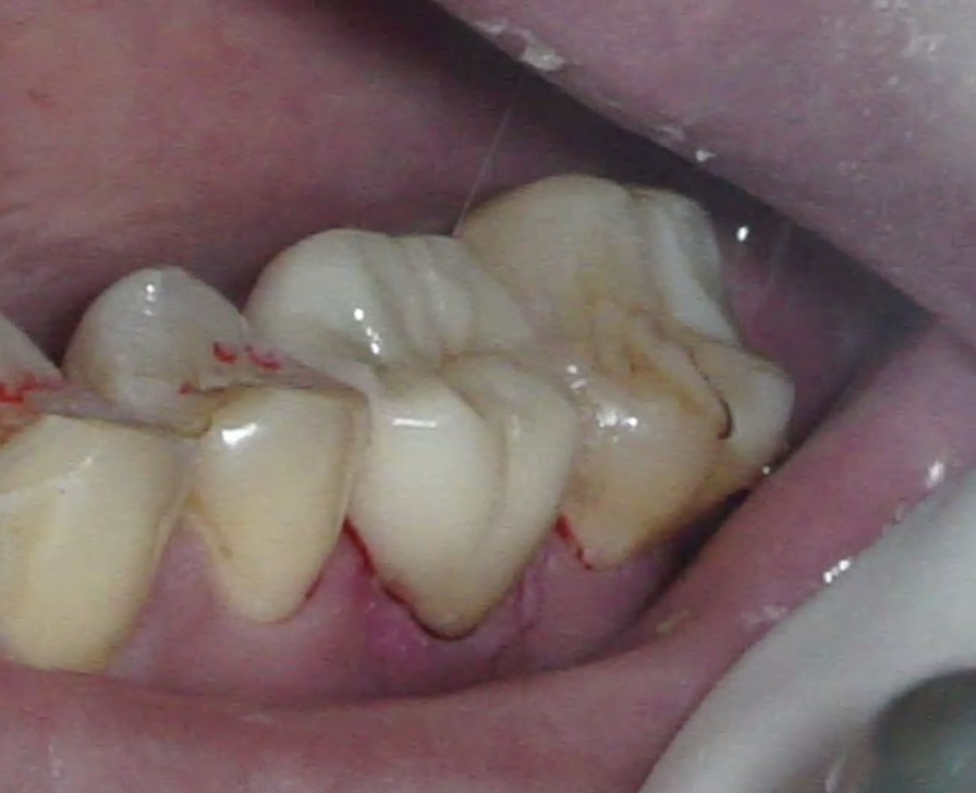 歯牙移植1 STEP8 セラミック修復