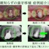 親知らずをインプラント代わりに自家歯牙移植したS様（20代男性）の症例紹介1です