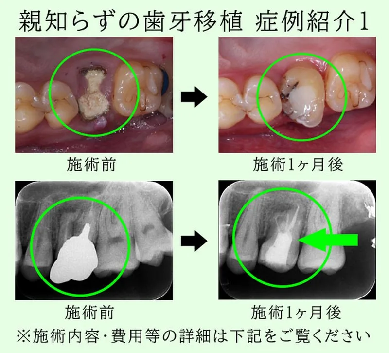 自家歯牙移植 親知らずをインプラント代わりに歯牙移植 症例紹介1 S様20代男性