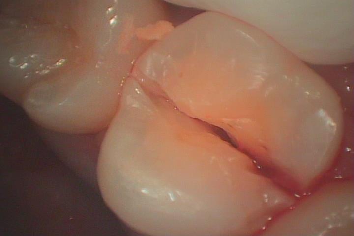 歯牙移植2 STEP1 抜歯の診断