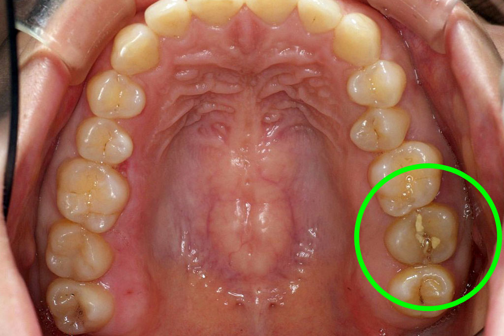 歯牙移植2 STEP11 施術前