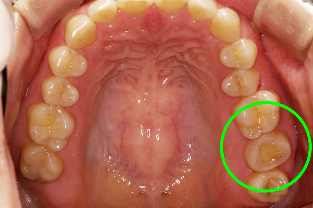 歯牙移植2 STEP11 施術後1ヶ月後