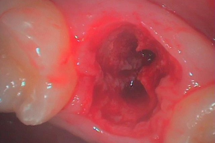 歯牙移植2 STEP2-1 抜歯後