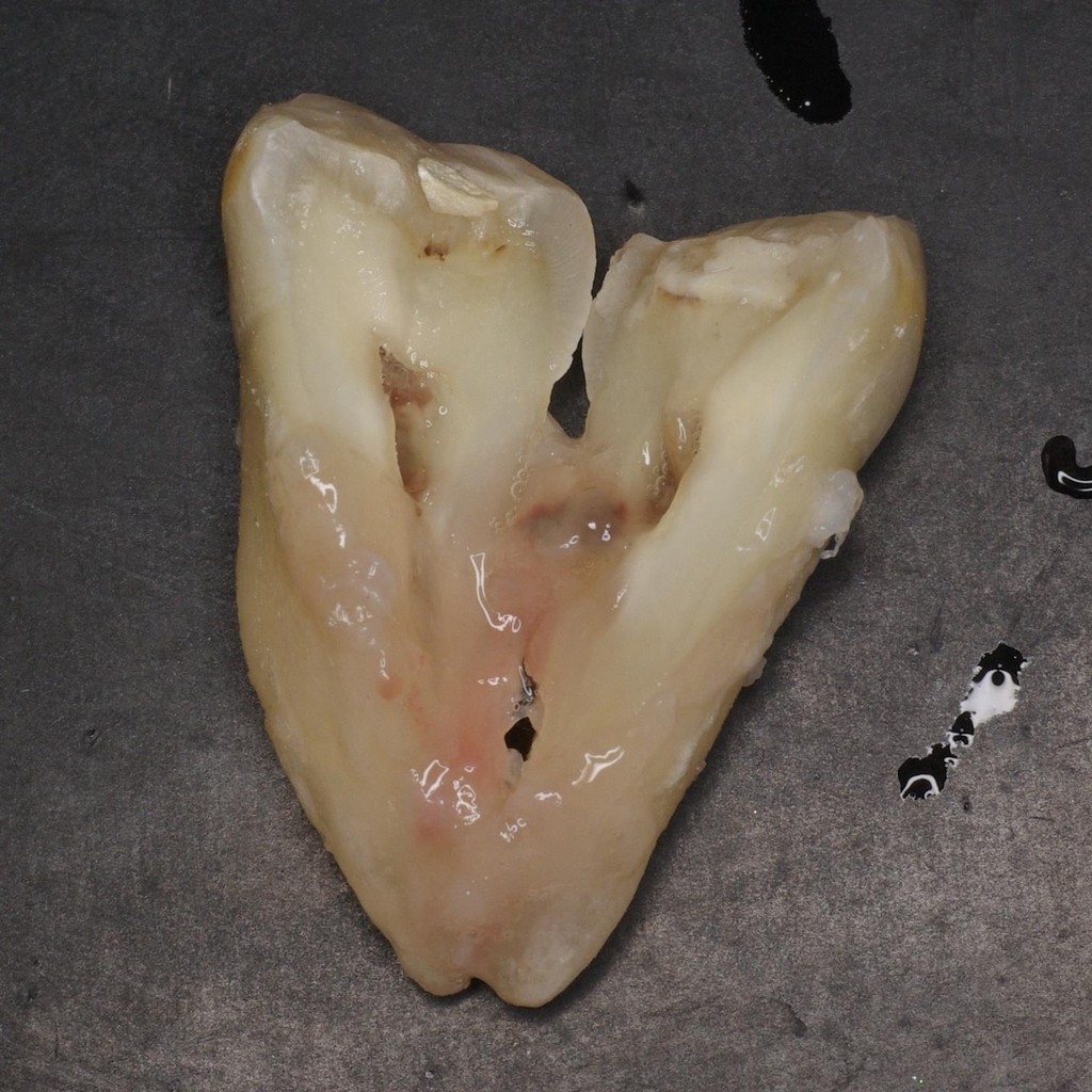 歯牙移植2 STEP2-2 破折歯