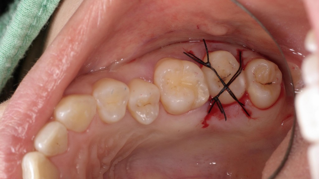 歯牙移植2 STEP4 歯の移植手術