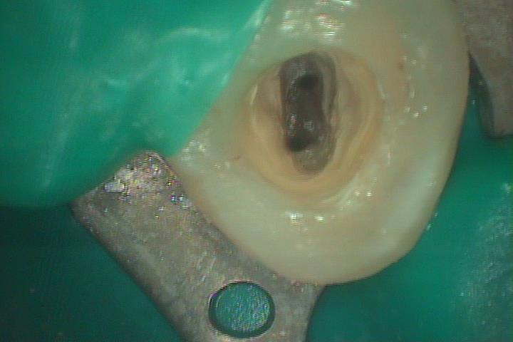 歯牙移植2 STEP5 根管治療