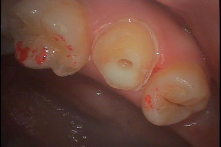 歯牙移植2 STEP6 支台歯形成