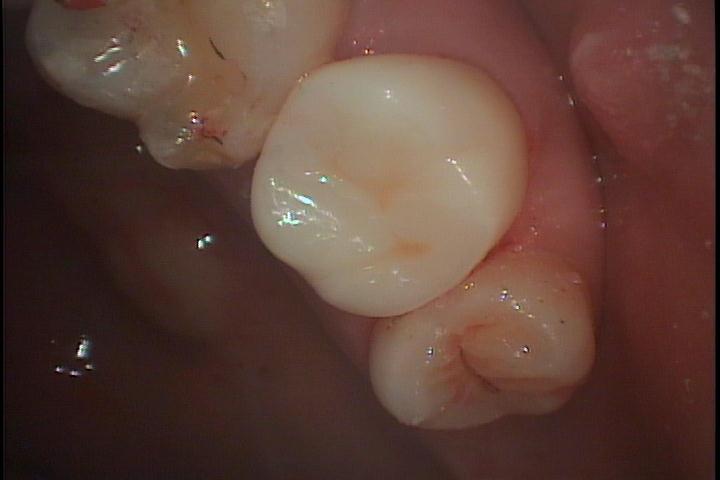 歯牙移植2 STEP7 セラミック修復