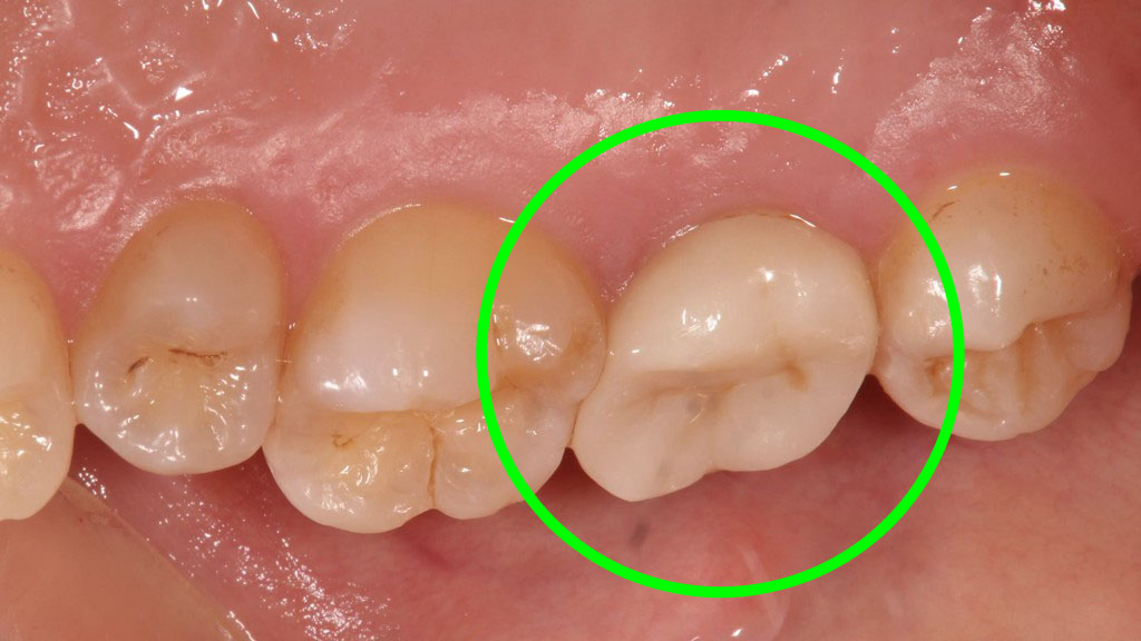 歯牙移植2 STEP8 施術後6年後