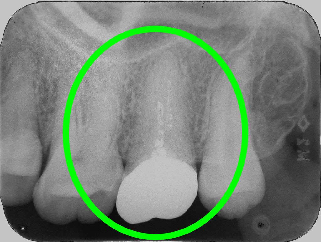 歯牙移植2 STEP9 施術後6年後のレントゲン