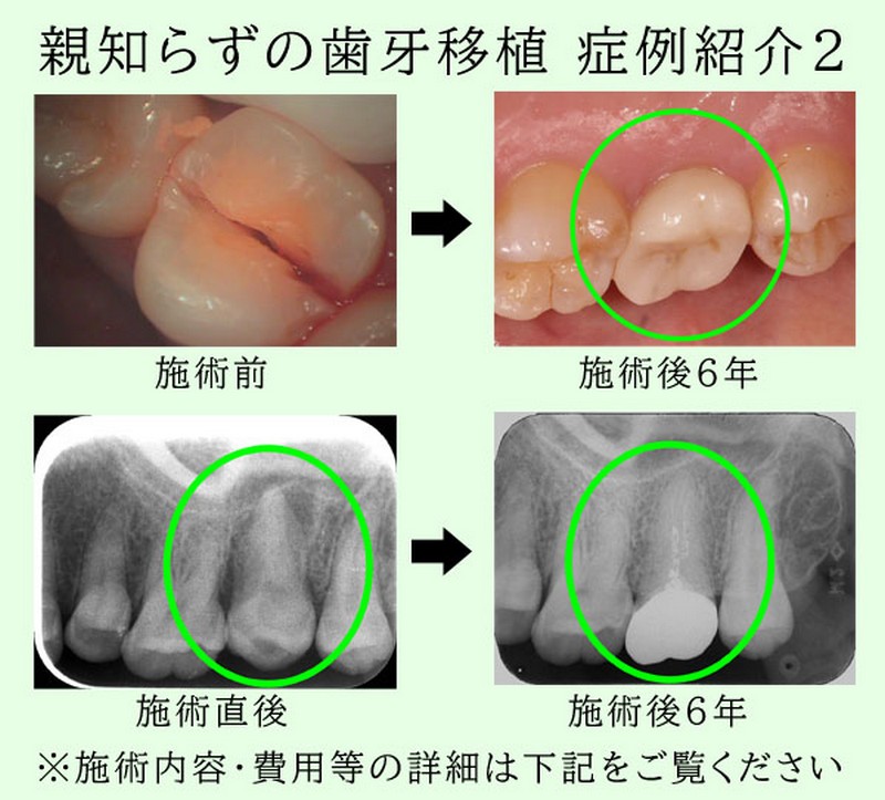 親知らずをインプラント代わりに自家歯牙移植したK様（30代女性）の症例紹介2です