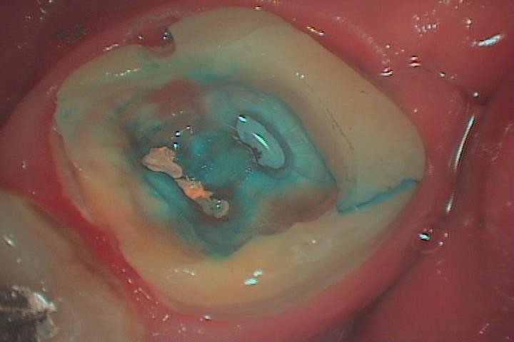 歯牙移植3 STEP1 抜歯の診断