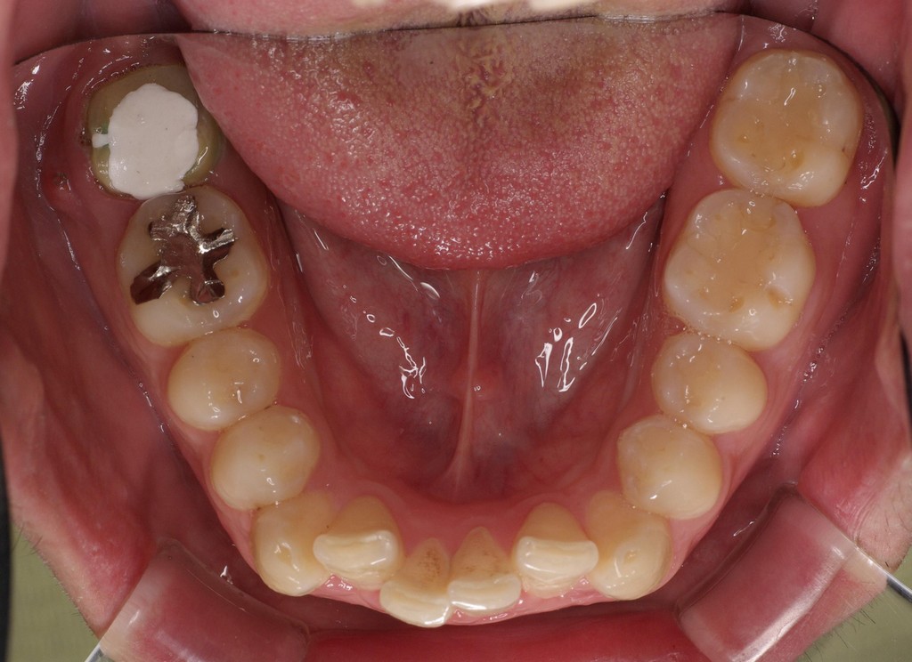 歯牙移植3 STEP10 施術前