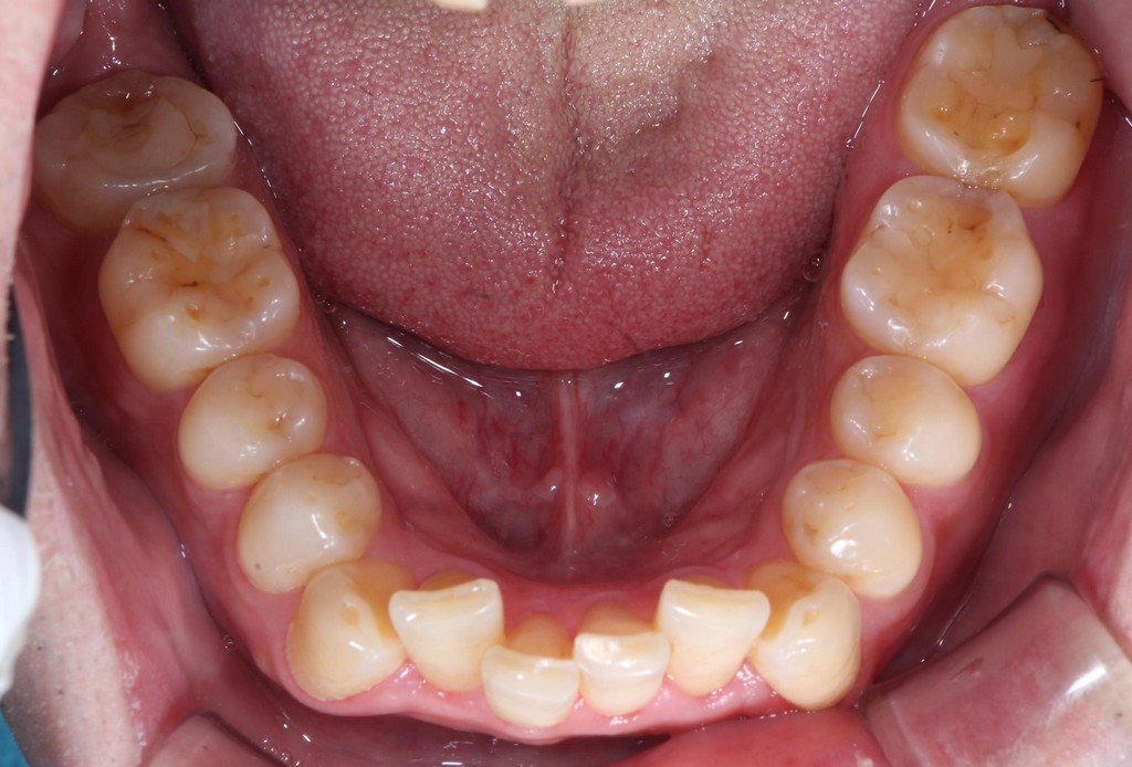 歯牙移植3 STEP10 施術後9年