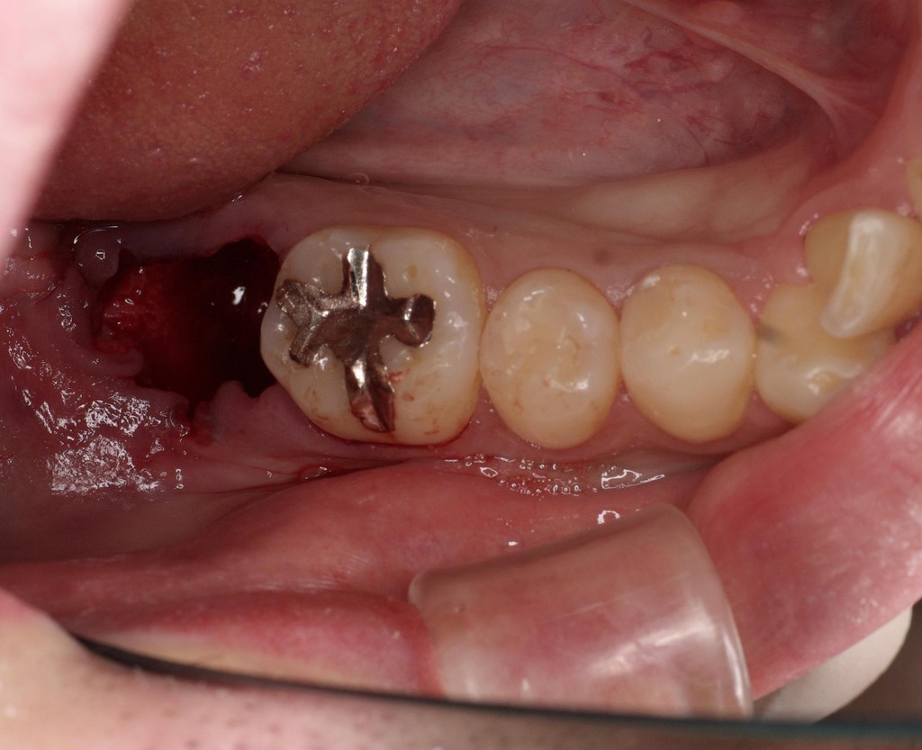 歯牙移植3 STEP3 抜歯後