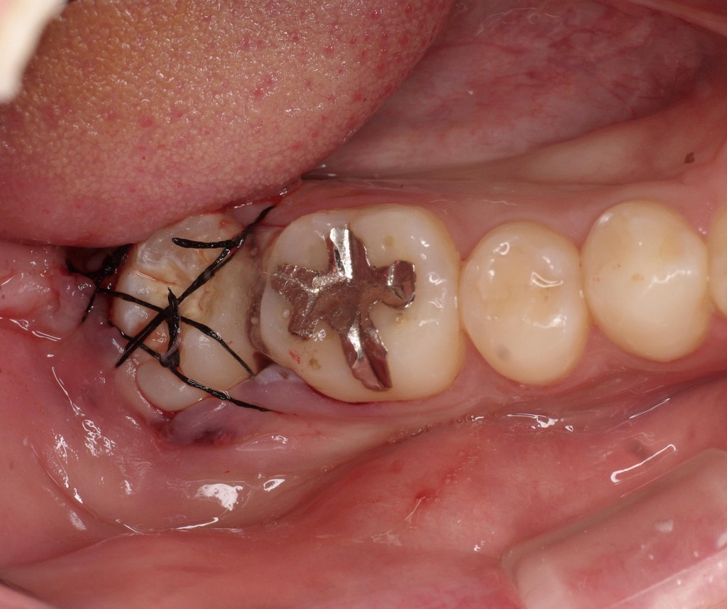 歯牙移植3 STEP5 歯の移植手術直後