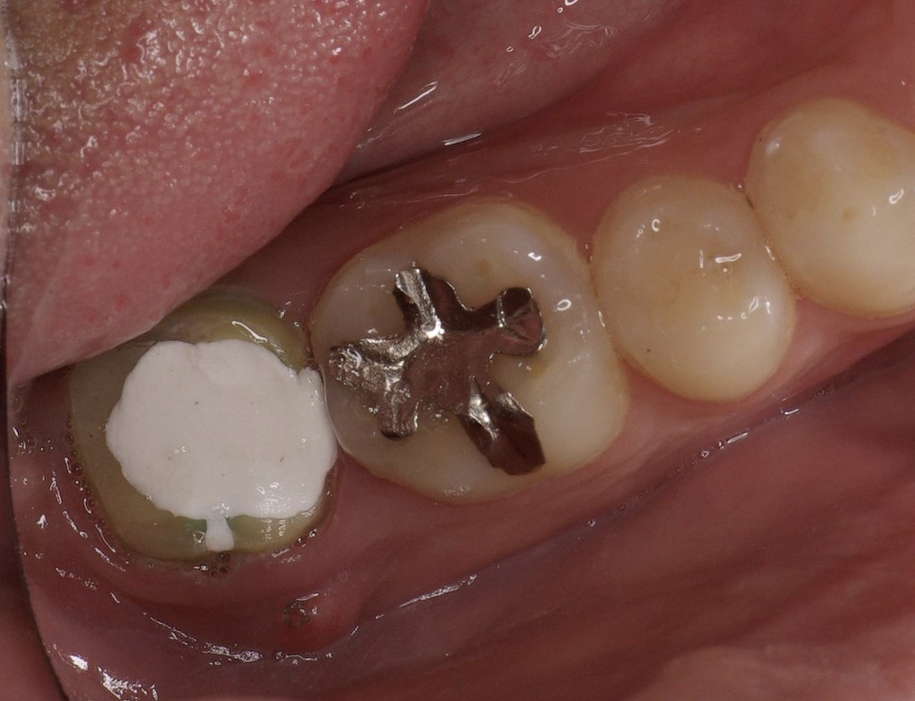 歯牙移植3 STEP8 施術前