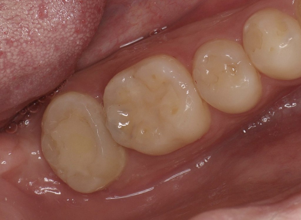 歯牙移植3 STEP8 施術後2年