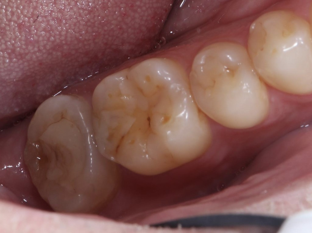 歯牙移植3 STEP8 施術後9年