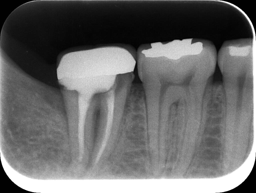 歯牙移植3 STEP9 施術前レントゲン写真