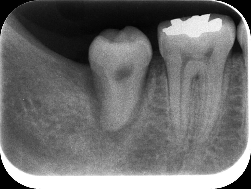 歯牙移植3 STEP9 施術直後レントゲン写真
