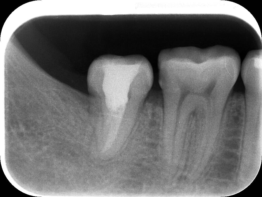 歯牙移植3 STEP9 施術後2年レントゲン写真