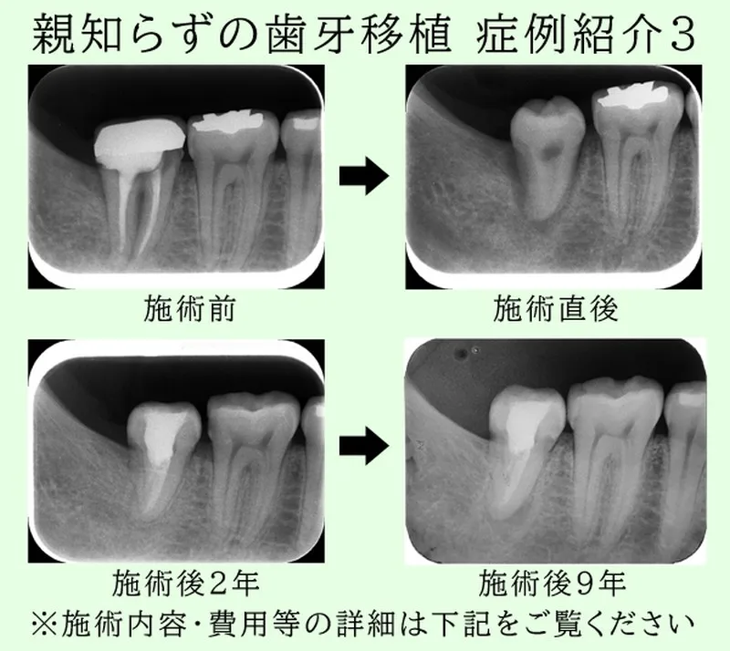 親知らずをインプラント代わりに歯牙移植 症例紹介3 T様20代男性