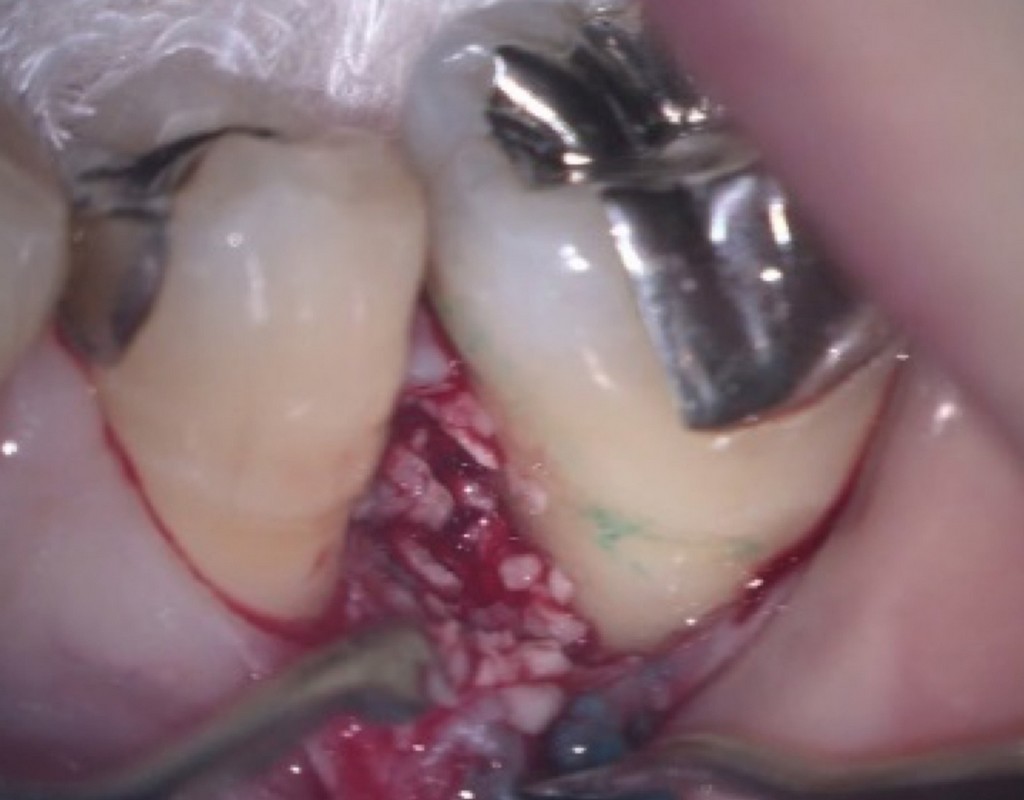 歯周病の再生治療