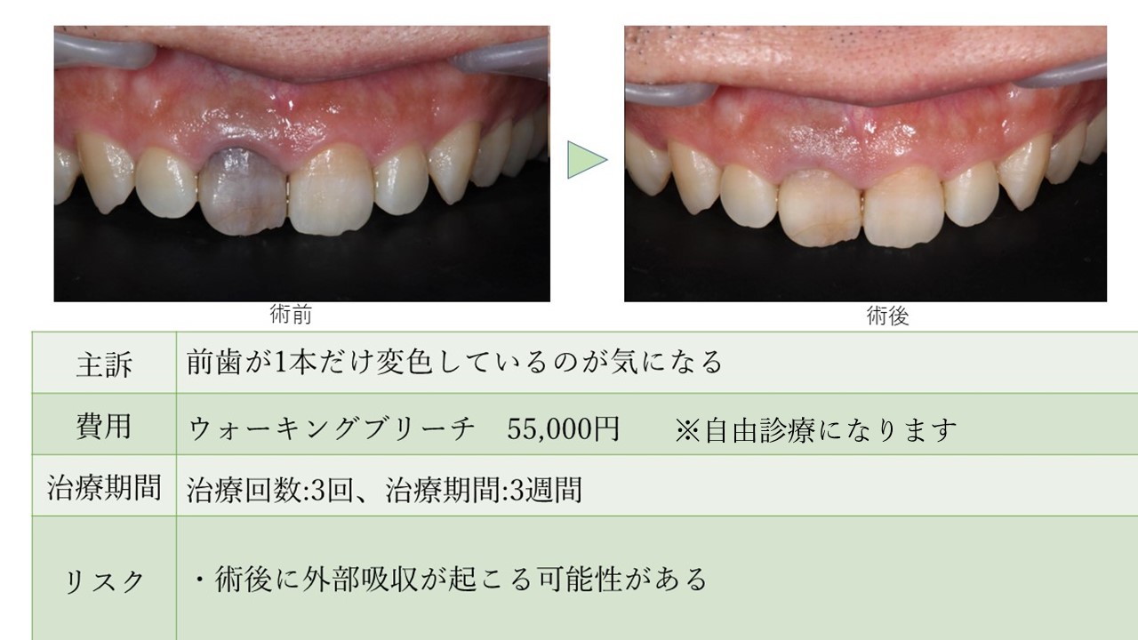 ウォーキングブリーチで前歯1本の変色が改善した40代男性A様の症例 