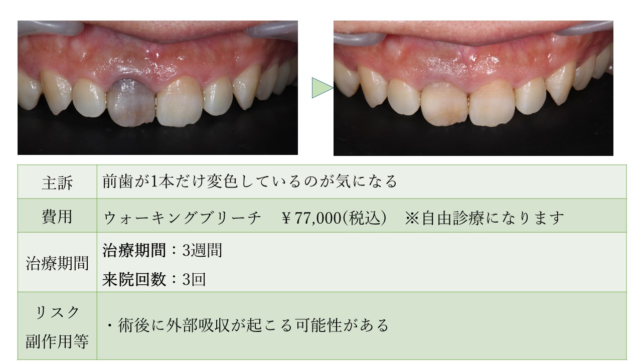 ウォーキングブリーチで前歯1本の変色が改善した40代男性A様の症例 
