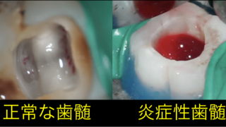 奥歯虫歯 正常な歯髄 炎症性歯髄