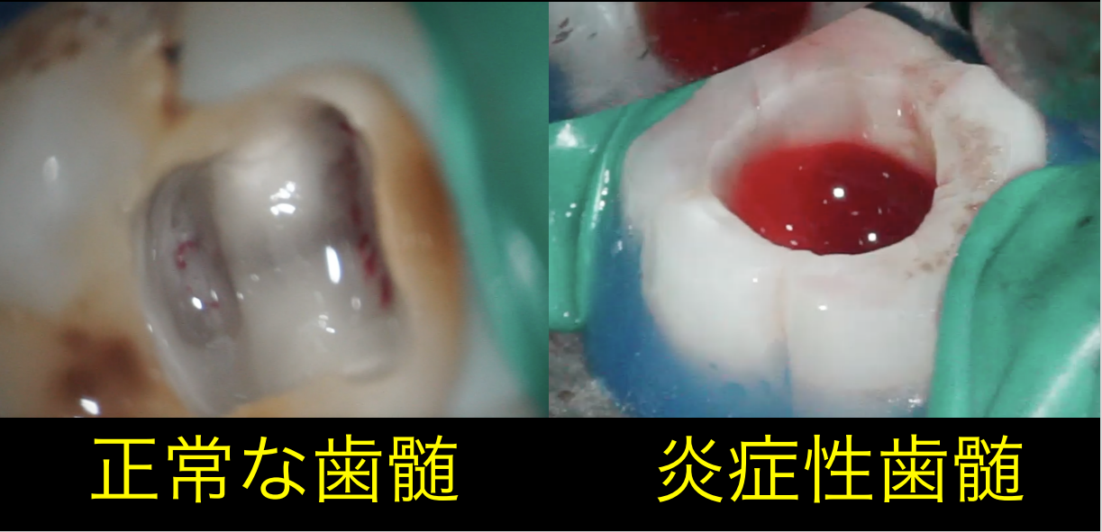 奥歯虫歯 正常な歯髄 炎症性歯髄