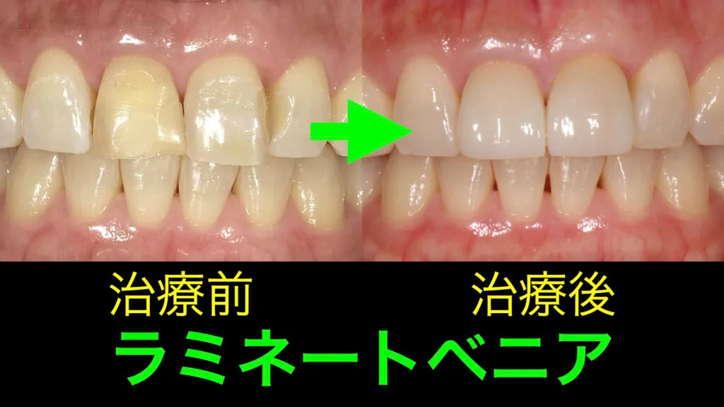 ラミネートベニアのビフォーアフター｜ほぼ歯を削らない治療の流れ