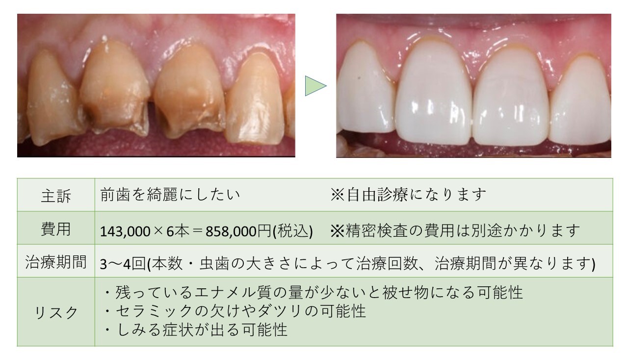 ラミネートベニアのビフォーアフター｜ほぼ歯を削らない治療の流れ 
