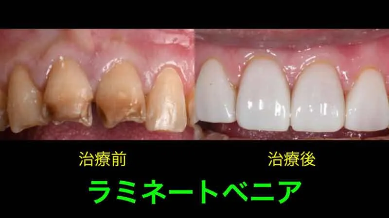 ラミネートベニアのビフォーアフター｜ほぼ歯を削らない治療の流れ