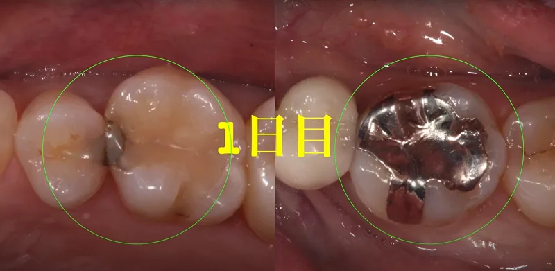 二日間で3本の歯を虫歯治療した症例（セラミック修復とダイレクト