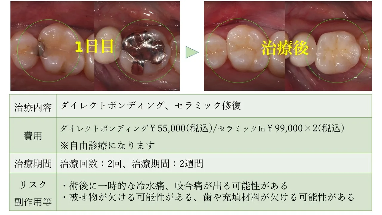 DBセラミックIn-2.jpg.webp