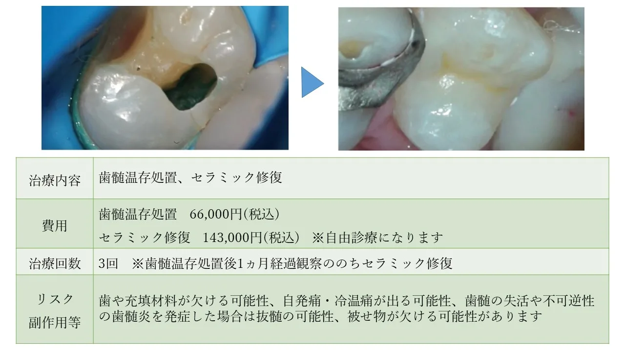 歯髄温存処置セラミック.jpg.webp