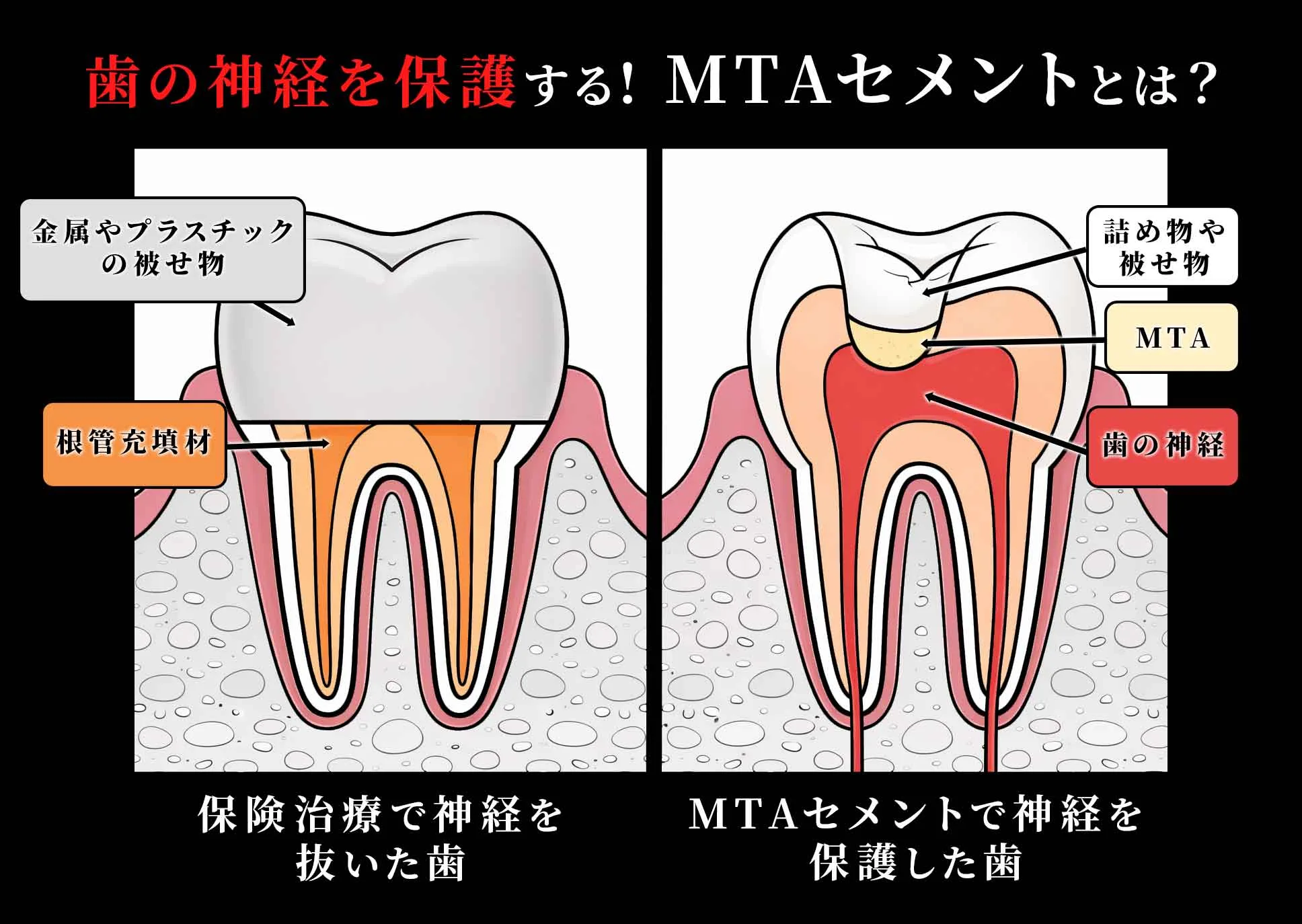 包括的歯科医療 mta-cement-eyecatch-02.jpg.webp