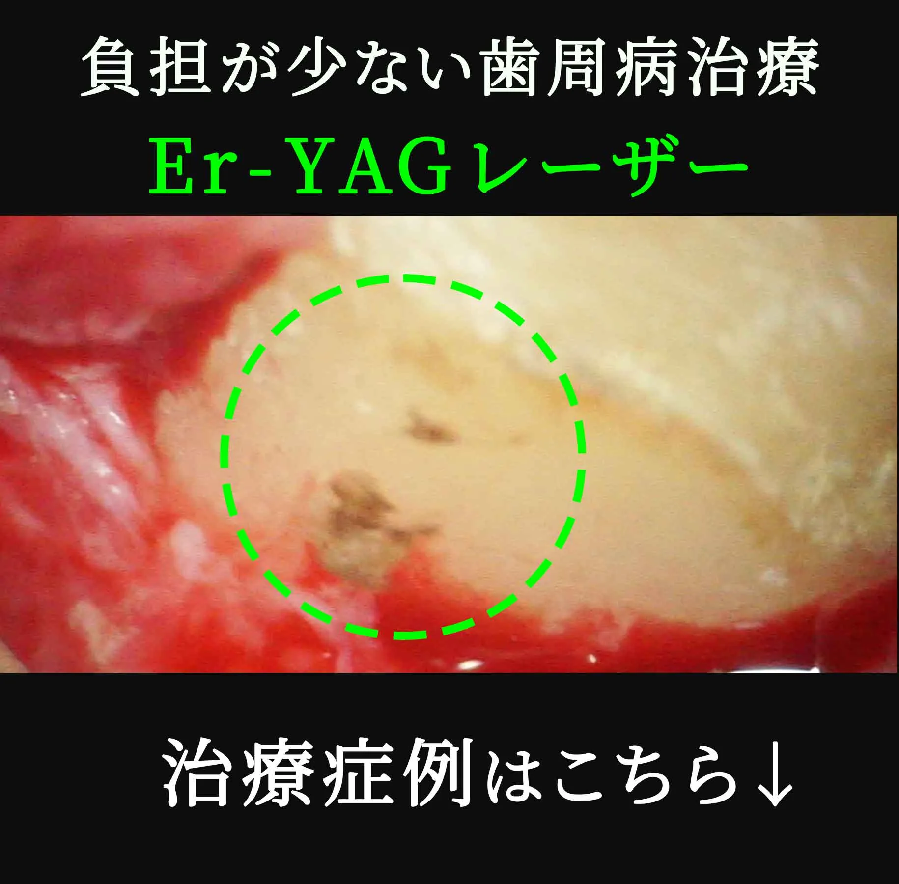 er-yag-laser-eyecatch.jpg.webp