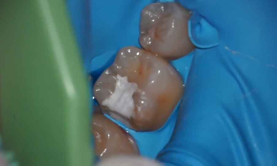 歯髄温存療法(VPT)の治療手順1：ラバーダムをかけた様子