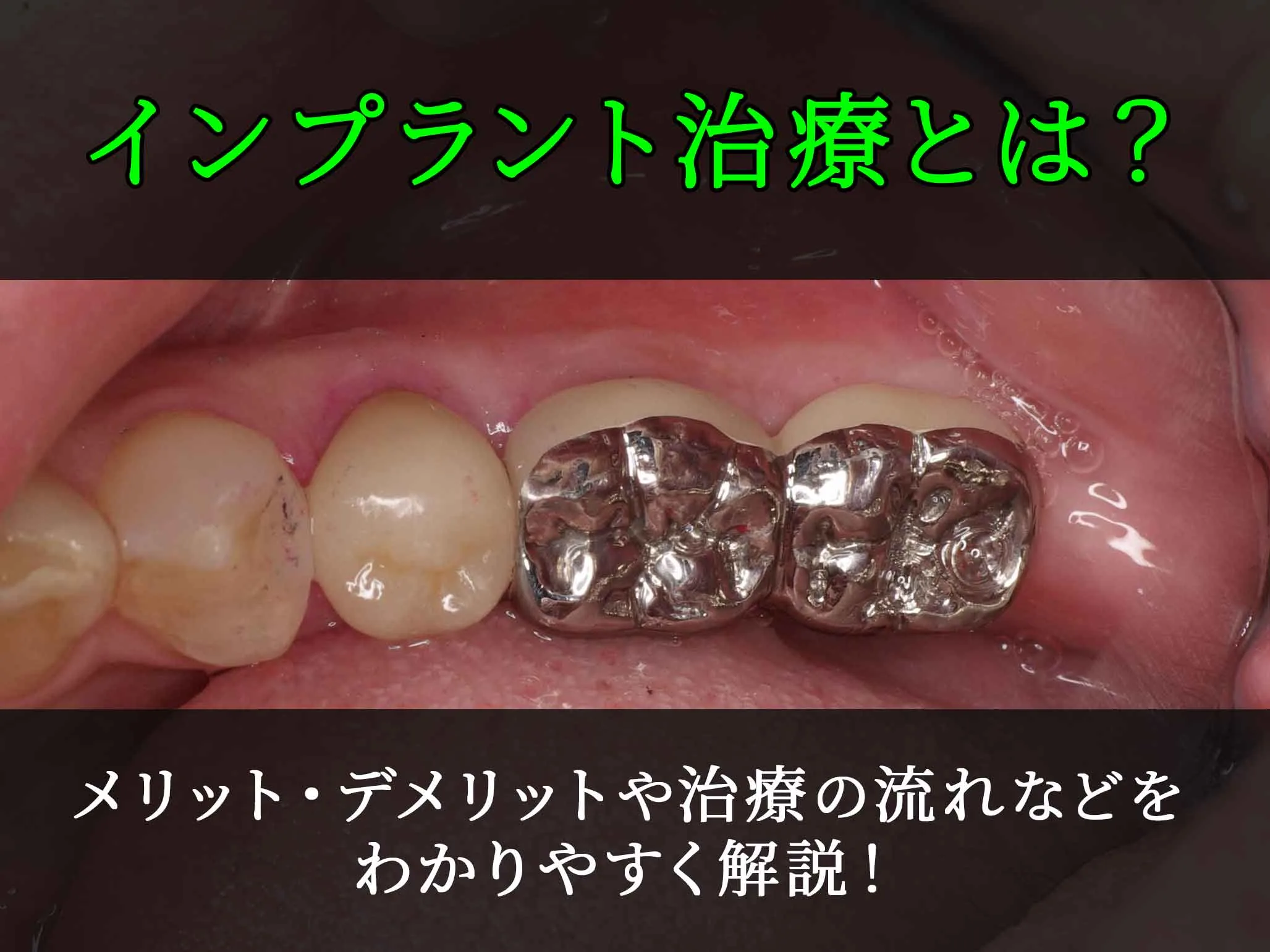 implant-eyecatch.jpg.webp
